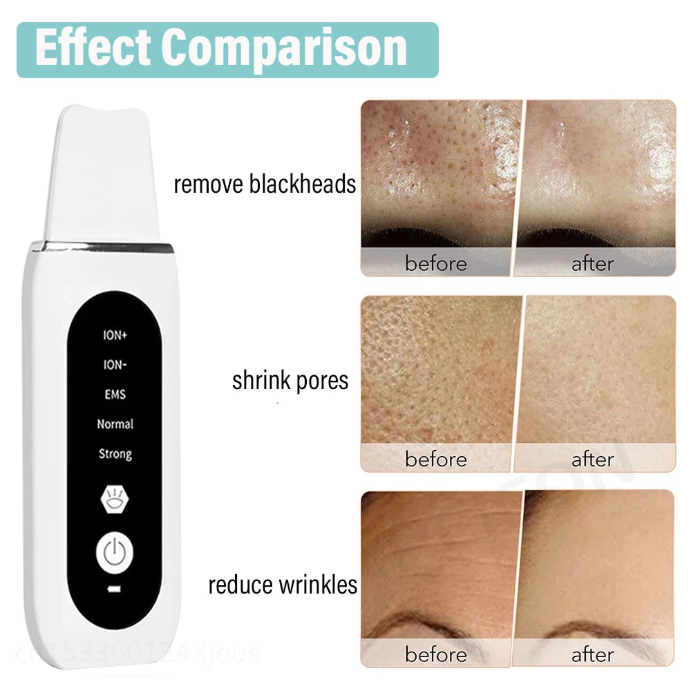 Ultrasonic Skin Scrubber Facial Peeling Machine Black Dots Acne Pore Deep Cleaning Ultrasonic Face Scrubber Blackhead Remover